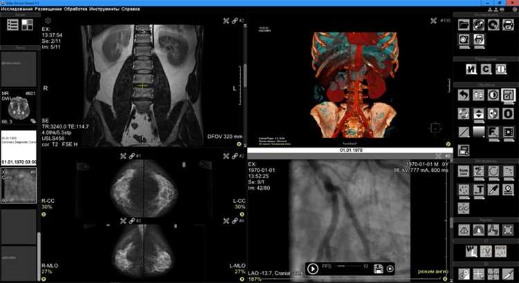 Скачать RadiAnt DICOM Viewer - программу для просмотра МРТ, КТ, УЗИ